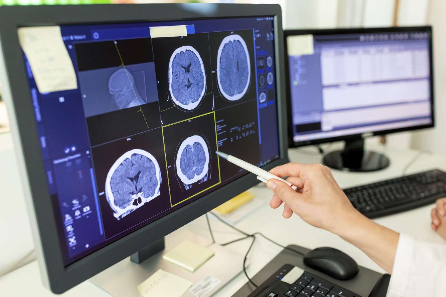Close-up de uma m&eacute;dica analisando o laudo de uma tomografia computadorizada em um monitor de computador
