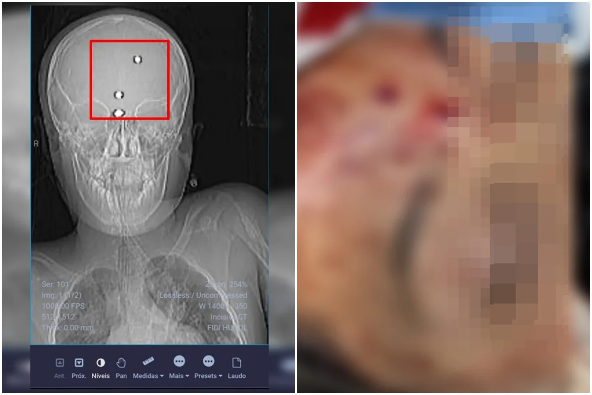 PCGO descarta acidente após exame mostrar 3 balas de chumbinho em menino