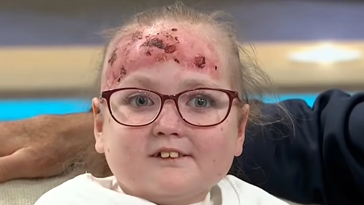 Doença rara deixa menina de 14 anos com bolhas e dor por todo o corpo