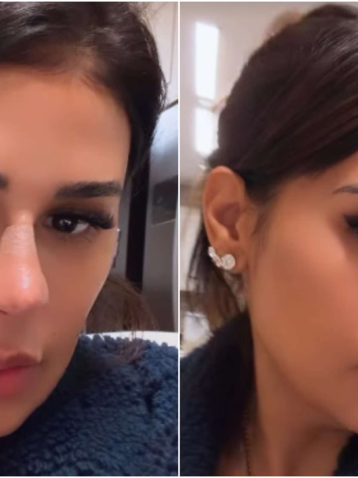 Simone Mendes fez plástica no nariz? Cantora revela procedimento realizado