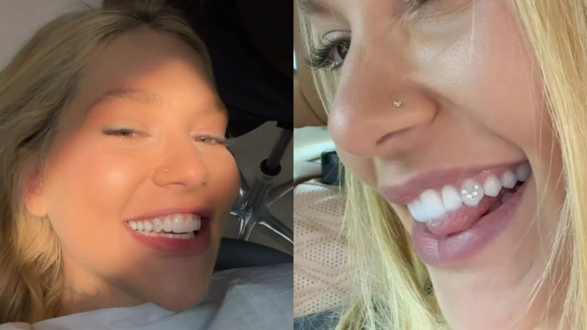 Joia nos dentes: dentista alerta sobre risco de tendência entre influencers