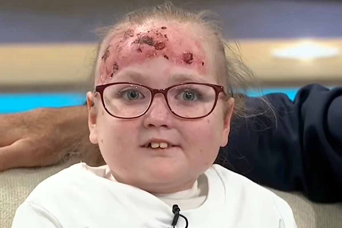 Doença rara deixa menina de 14 anos com bolhas e dor por todo o corpo