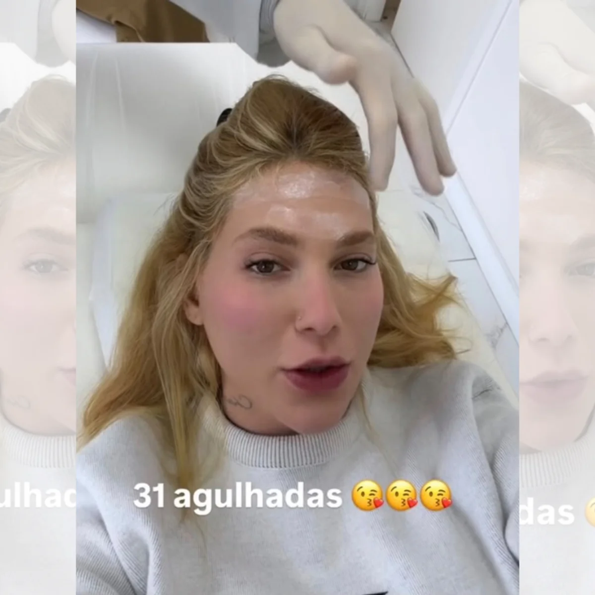 Virginia faz 31 aplicações de botox na cabeça; médica explica procedimento
